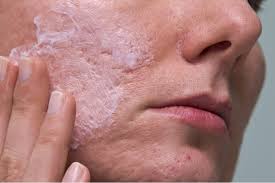 Vitamin e helps acne and acne scars to heal faster and also regulates the production of collagen. Vitamin C For Acne Scars Efficacy How It Works Before And Afters