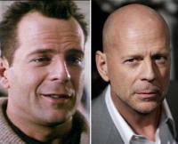 Hollywood celebs with hair loss (before hair and after hair): Celebrity Hair Loss
