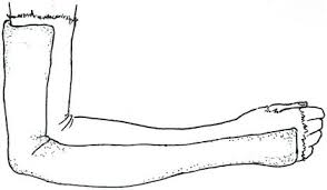 Image result for Long Arm Splint