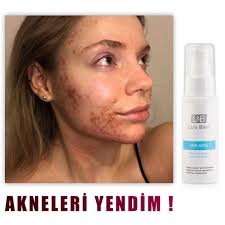 Akne Sivilce Ve Siyah Noktalar Icin Mucizevi Krem B3 Vitamini Iceren Formuluyle Anti Akne Bakim Kremi Cilt Yatistiric Siyah Noktalar Cilt Urunleri Krem