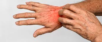 Image result for Scabies