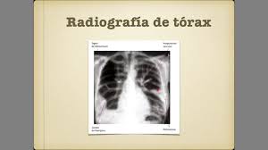 Trombosis venosa profunda y tromboembolismo pulmonar. Tromboembolia Pulmonar Youtube