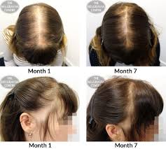 This is because it adds texture and a tousled finish to thin hair. Hair Loss Treatment For Women Female Pattern Hair Loss Current Treatment Concepts