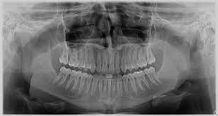 Ce type de radio peut également permettre au. Radiografii Dentare 2d In Cluj Napoca