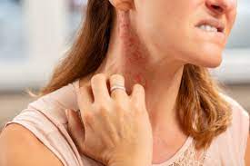 How Do You Get Rid Of An Allergic Reaction Rash Oak Brook Allergists