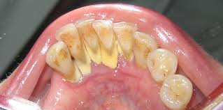 It can be easily removed with daily oral care. Calculus Dental Wikipedia