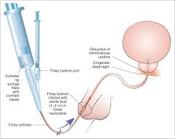 Image result for Retrograde Urethrogram