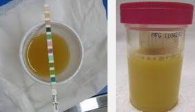 Set kencing kotor dari shaklee. 12 Tanda Tanda Anda Diserang Kencing Kotor Cute And Beauty
