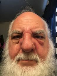 Getting stung by russian bees