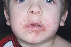 Image result for yellow scabs on the face in children