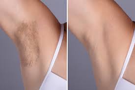 There is some discomfort in both hair removal systems, because the light warms up the skin and the hair, causes some itching and pinch sensation. Is Ipl Laser Hair Removal Painful