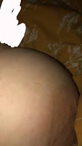 Here are the breast cancer warning signs you should know like the back of your hand. Dimples On Breast Breast Cancer And Screening Forums Patient