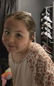 BREAKING NEWS‼️ Local kid tries to fake a case of chickenpox to skip  school. Sources say the red sharpie gave her away. 🫣🥴