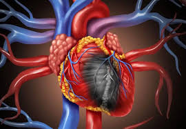 AI已能精准定位心梗病变血管，有望提供高效预警信号