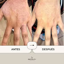 Image result for dermatitis contacta