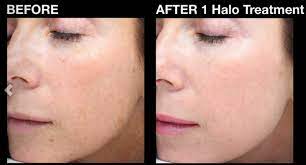 Halo hybrid fractional laser before and after. I Had The Halo Laser Treatment Here S What Happened