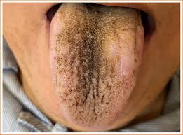 Image result for black hairy tongue symptoms