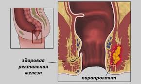 Mozhet Li Podnyatsya Temperatura Ot Vospaleniya Gemorroya