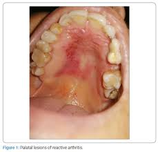 Image result for Erythroplakia roof of mouth