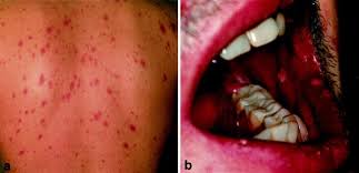 Image result for skin rash acute hiv infection
