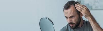If the condition is detected early belle suffers from hair loss and thinning on her hairline. Are You Balding Toppik Blog