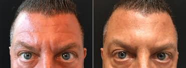 What to know about laying down after botox. Male Botox For Forehead Lines And Frown Lines Before And After Photos New Jersey