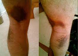 Recovery time depends on how badly you injured the hamstring. Pulled Hamstring Wikipedia