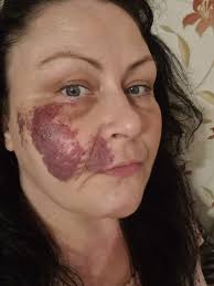 IDNC that i have a port wine stain