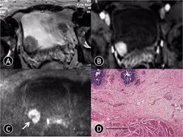 However, as with other types of cancer,. Frontiers Combined T2 Spair Dynamic Enhancement And Dw Imaging Reliably Detect T Staging And Grading Of Bladder Cancer With 3 0t Mri Oncology