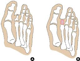 Image result for toe amputation