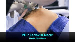 Prp Tedavisi Nedir Diz Cilt Ve Sac Tedavi Ve Iyilestirmek Icin Kullanilir Prp Diz Tedavisi Kikirdak Doku Onariminda Yardimci Tedavi Olarak Uygula Sac Dokular