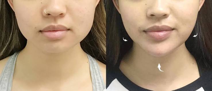 Best Chin Filler Malaysia | Non-Surgical Chin Augmentation - NextMed Clinic