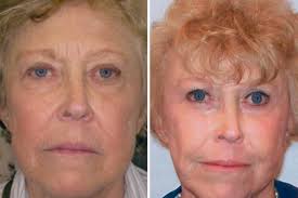 Face-lifts are down, but not