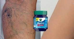 Remedios Naturales Para Eliminar Las Varices Y Aranitas Enunsegundo