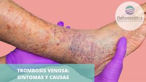 Cualquier cosa que impida que la sangre circule o se coagule normalmente puede ocasionar un coágulo sanguíneo. Que Sintomas Tiene Una Trombosis Venosa En Las Pierna Coronavirus Youtube
