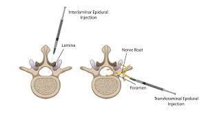 Image result for Lower Cervical Intramuscular Injection