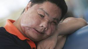 The ethical considerations of face transplants