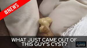 Look Away Now Cyst Is So Badly Infected That Pus Comes Out Of It Like Custard