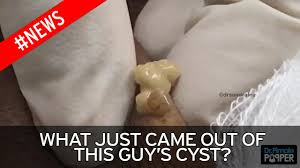 look away now cyst is so badly infected that pus comes out of it like custard