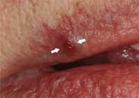 Image result for Diascopy