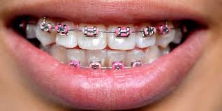 Harga rp 50.000, anda akan dapatkan 1 pack karet behel isi 40 stik. Cara Merawat Behel Fashion Serta Pemasangannya