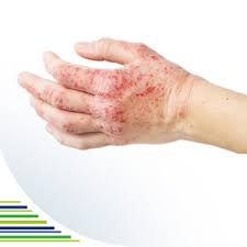 Image result for vyrážka u dětí