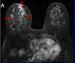 Learn more about cat scans today. Expert Opinion Imaging And Lobular Breast Cancer The Lobular Breast Cancer Alliance