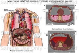 See more ideas about figure drawing, anatomy drawing, anatomy reference. Male Torso With Post Accident Thoracic And Abdominal Injuries Medical Illustration Human Anatomy Drawing Anatomy Illustration