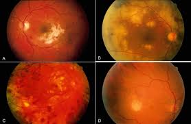 Image result for HIV Retinitis