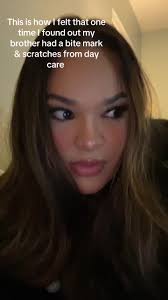 Measuring Bite Marks Kid