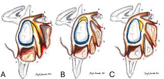 Image result for SLAP Lesion
