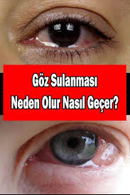 Goz Sulanmasi Ve Bulanik Gorme Neden Olur Nasil Gecer Gozler Saglik Ipuclari Dogal Tedaviler