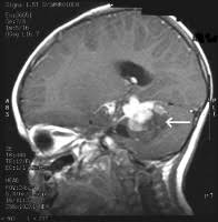 Cancerous tumors can be divided into primary tumors, which start within the brain, and secondary tumors. Brain Cancer