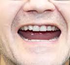 Implantes dentales en Union City, NJ | Diana Rodriguez, DMD